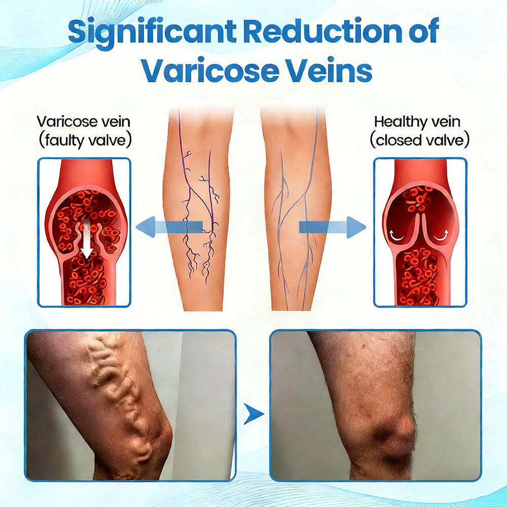✨ Alcuras™ Advanced Vein Healing Spray | Fade Varicose & Spider Veins