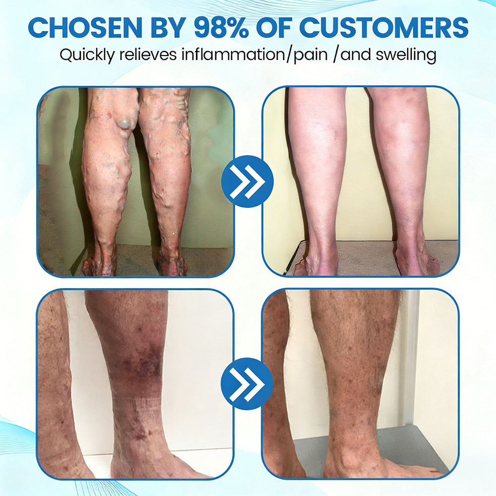 ✨ Alcuras™ Advanced Vein Healing Spray | Fade Varicose & Spider Veins