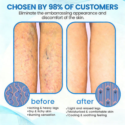 ✨ Alcuras™ Advanced Vein Healing Spray | Fade Varicose & Spider Veins