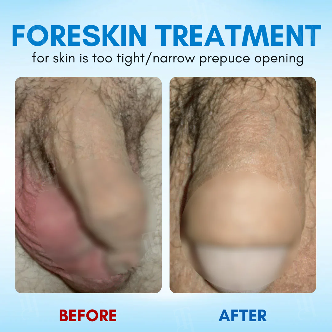 ⚡Alcuras® Foreskin Elasticity Gel: Restore Your Edge, Restart Your Vitality.